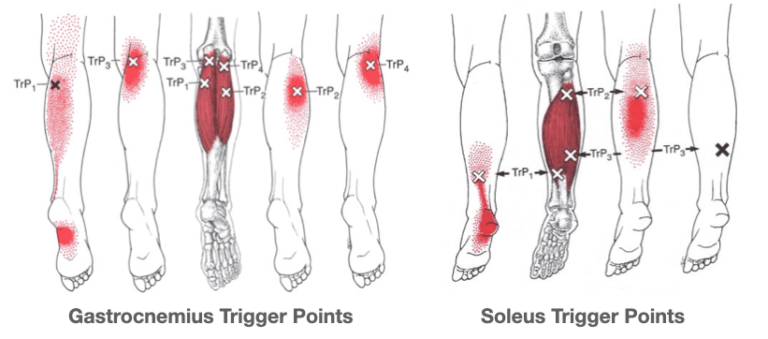 Trigger Points For Plantar Fasciitis How To Find And Release