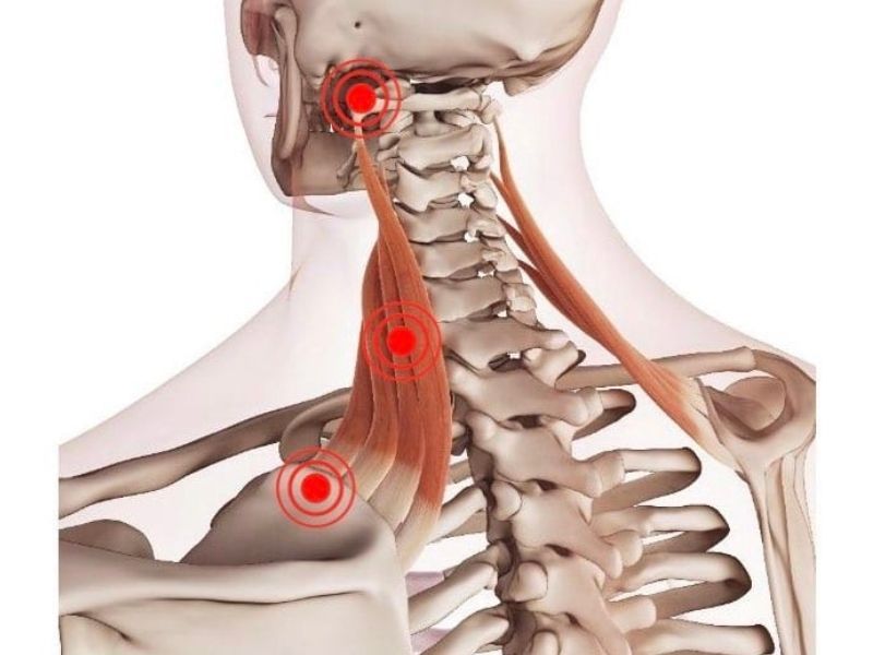 Levator Scapulae Pain: and Finding Relief