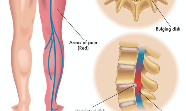 Sciatica Trigger Points