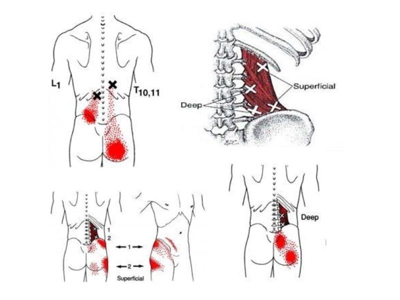 Low Back Trigger Points