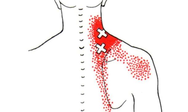 Levator Scapulae Trigger Points