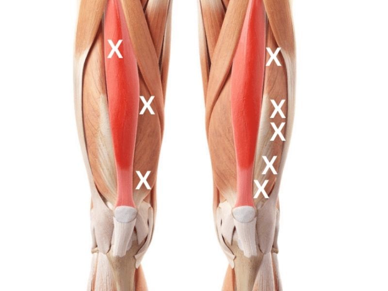 Quadriceps Trigger Points Locations