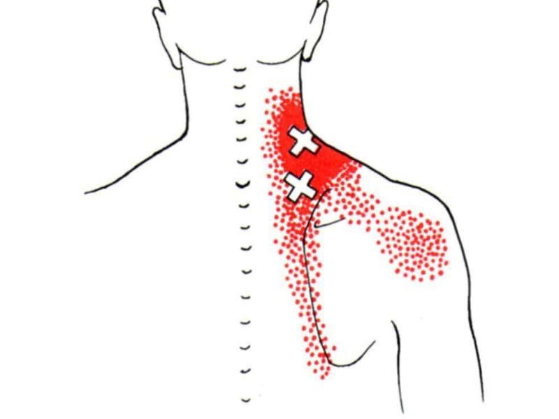 Levator Scapulae Trigger Points