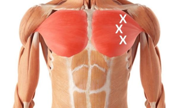 Pectoralis Trigger Points | How To Find And Release