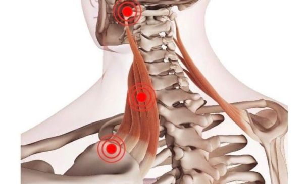 Levator Scapulae Pain: and Finding Relief