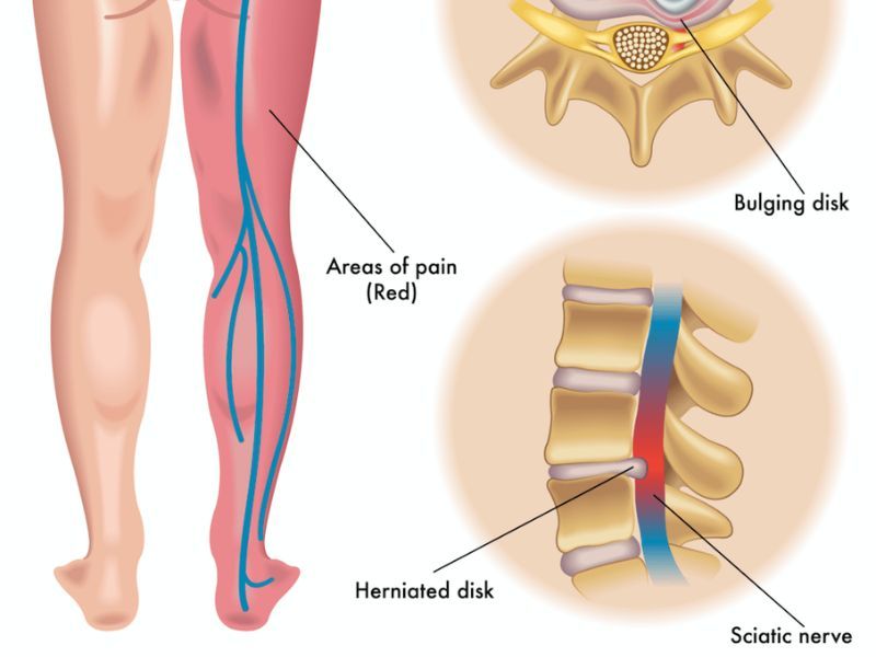 Sciatica Trigger Points