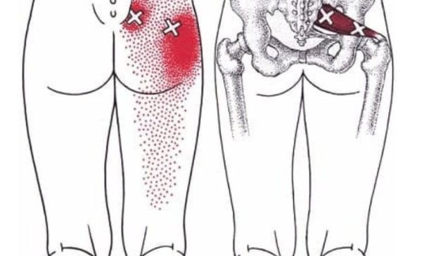 Piriformis Trigger Points min