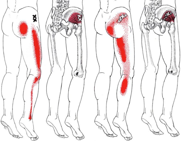 Gluteus Minimus Trigger Points | Pain, Symptoms, and Finding Relief