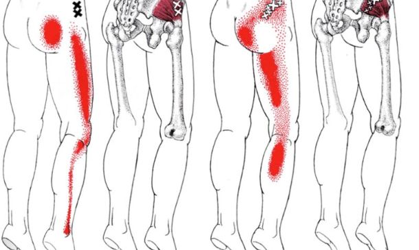 Gluteus Minimus Trigger Points | Pain, Symptoms, and Finding Relief