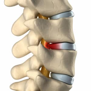 Can Massage Therapy Help with Herniated Discs