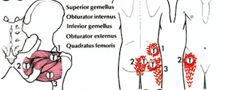 Sciatica Trigger Points | Can Treating Them Help?