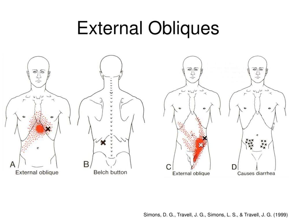 External-Oblique-Trigger-Points