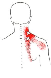 Levator Scapulae Trigger Points | How To Identify And Self-Release