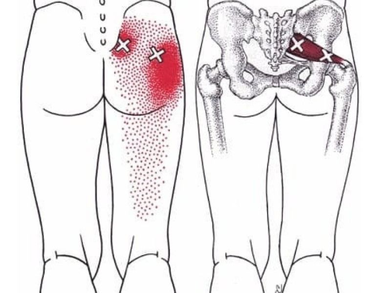Piriformis Trigger Points
