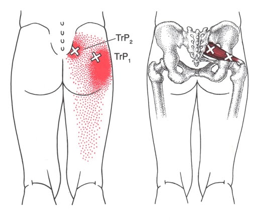 Piriformis Trigger Points Double Trouble XGTHQ