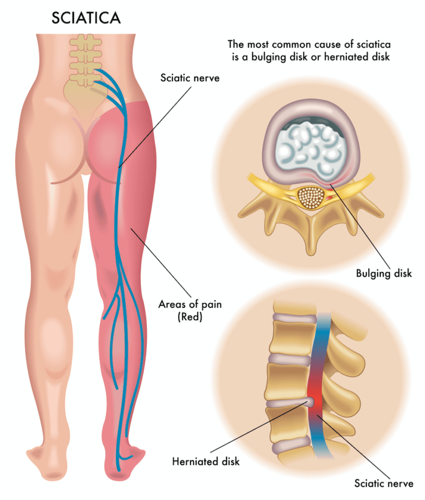 Lower Back Trigger Points - A Key To Lower Back Pain Relief