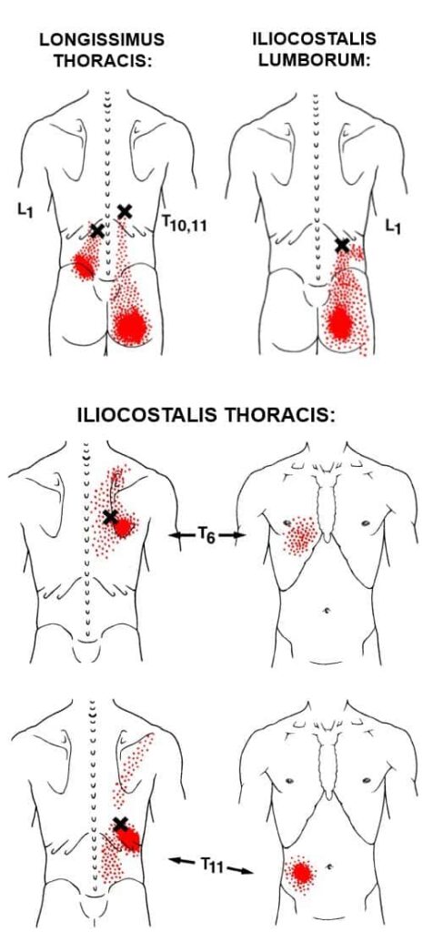 Low Back Trigger Points - Pain Relief Techniques