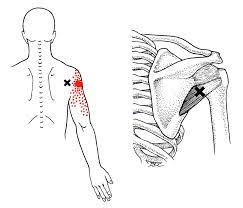 Teres-Trigger-Points