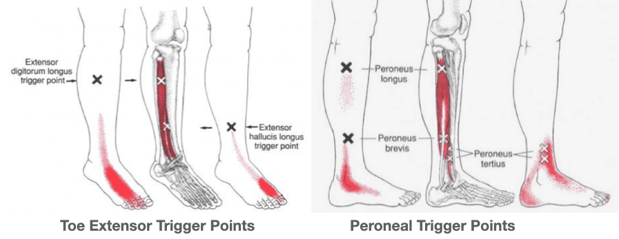 Trigger-Points-Peroneals-min