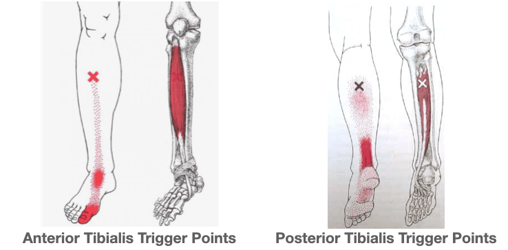 Trigger-Points-Tibialis